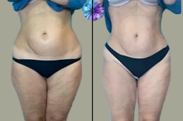 Aqualyx Injection Dubai before and after