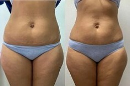 Aqualyx Injection in Dubai before and after