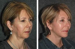 Before and after Bio Revitalization Treatment in Dubai