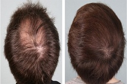 Before and after G Cell Hair Treatment Dubai