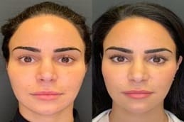 Before and after Skin Booster Injection in Dubai