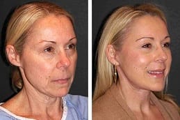 Bio Revitalization Treatment in Dubai Before and after