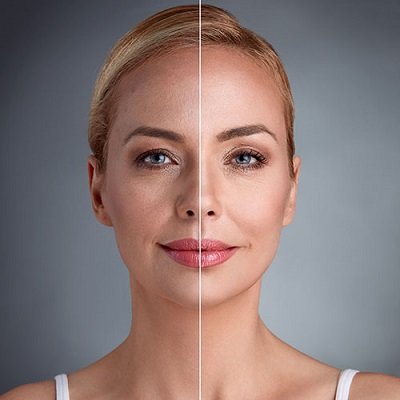 Facial Fat Grafting in Dubai