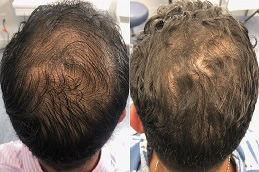 G Cell Hair Treatment Dubai before and after