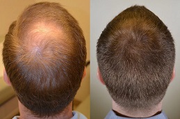 G Cell Hair Treatment in Dubai before and after