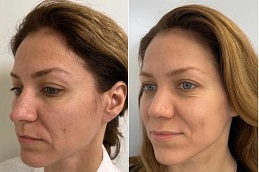 Morpheus 8 Dubai before and after