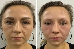 Skin Booster Injection Dubai before and after