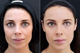 Skin Booster Injection in Dubai before and after