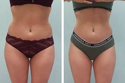 before and after Aqualyx Injection Dubai