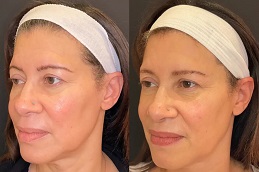 before and after Morpheus 8 Dubai