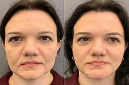 before and after cheek fillers in Dubai