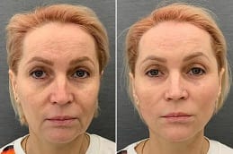 cheek fillers Dubai before and after