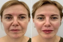 cheek fillers in Dubai before and after