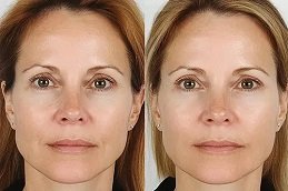 Before and after Belotero Fillers in Dubai