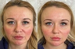 Before and after Filler Injections with PRP in Dubai