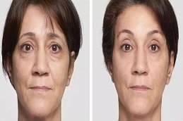 Before and after Volite Fillers in Dubai