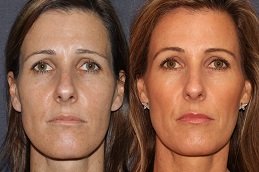 Belotero Fillers Dubai before and after