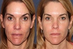 Belotero Fillers in Dubai before and after
