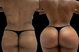Body Fillers Dubai before and after