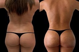 Body Fillers in Dubai before and after