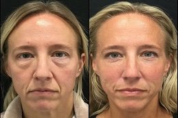 Filler Injections with PRP Dubai before and after