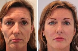 Filler Injections with PRP in Dubai before and after