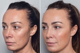 Morpheus 8 in Dubai before and after