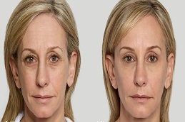 Volite Fillers Dubai before and after