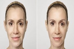 Volite Fillers in Dubai before and after