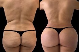 before and after Body Fillers in Dubai