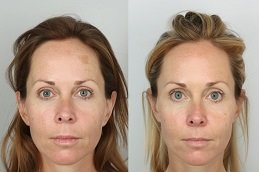 before and after Sculptra Fillers in Dubai
