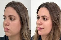 Before and after Hifu treatment in Dubai