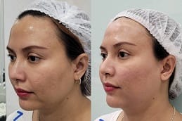 Hifu treatment in Dubai Before and after