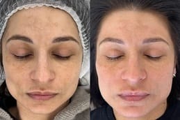 Before and after Microneedling Treatment in Dubai