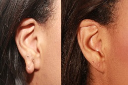 Keloid Treatment Dubai before and after