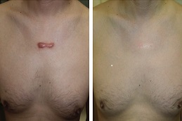 Keloid Treatment in Dubai before and after