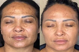 Microneedling Treatment Dubai before and after