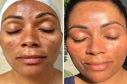 Microneedling Treatment in Dubai before and after