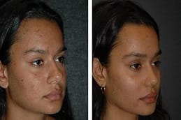 Red Carpet facial Dubai before and after