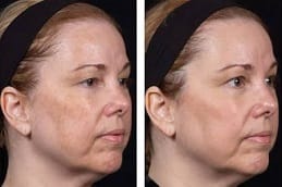 Red Carpet facial in Dubai before and after