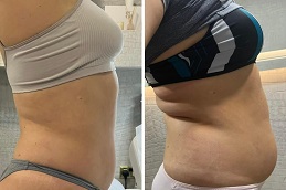 Wegovy Injection Dubai before and after