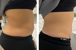 Wegovy Injection in Dubai before and after