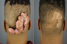 before and after Keloid Treatment in Dubai