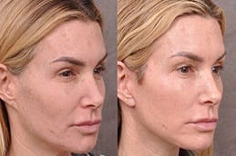 before and after Red Carpet facial in Dubai