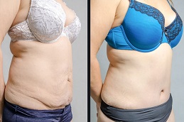 before and after Wegovy Injection in Dubai