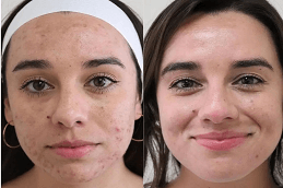 before and after pimples treatment in Dubai