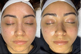 deep cleansing facial dubai before and after