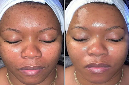 deep cleansing facial in dubai before and after