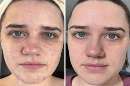 pimples treatment Dubai before and after