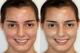 pimples treatment in Dubai before and after